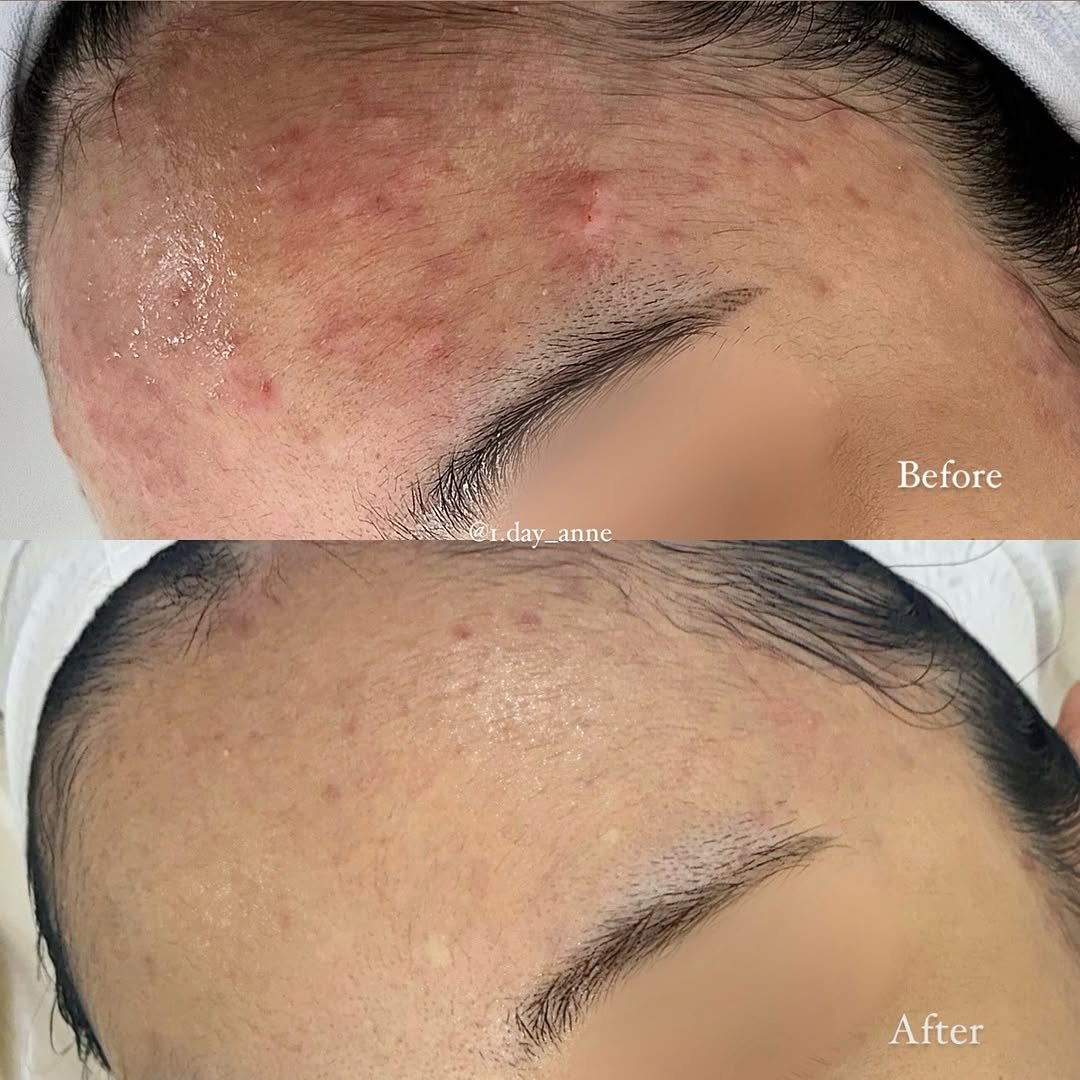 1.day_anne 게시물 이미지: 오실 때마다 오랜 시간을 들여
경상남도 양산에서 피부 개선을 위해 찾아와 주시는...