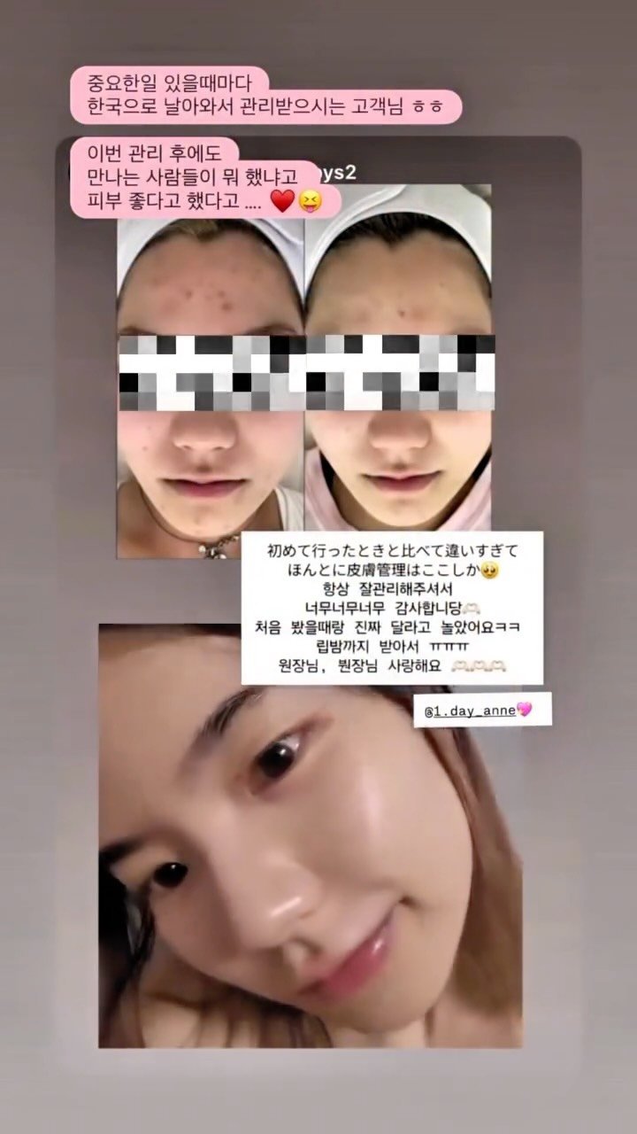 1.day_anne 게시물 이미지: 🇯🇵✈️일본 고객님이 직접 인스타 스토리에 올려주신 비포&애프터🤍

몇 년 전...