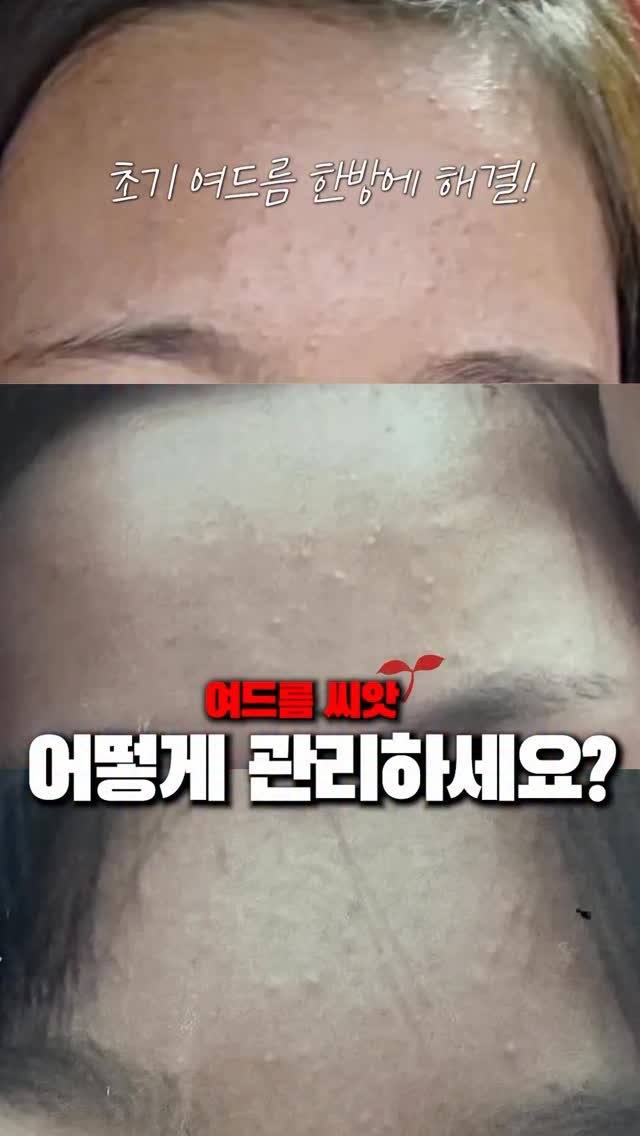 1star2star_ 게시물 이미지: 여드름 초장에 잡는 치트키!!!! 진짜 꼭 한 번 해보세요
