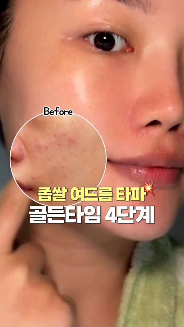 1star2star_ 게시물 이미지: 📌 좁쌀여드름 4단계 관리 정리

1️⃣ 효소 파우더 (구달 피그 애씨드 펩타이드...