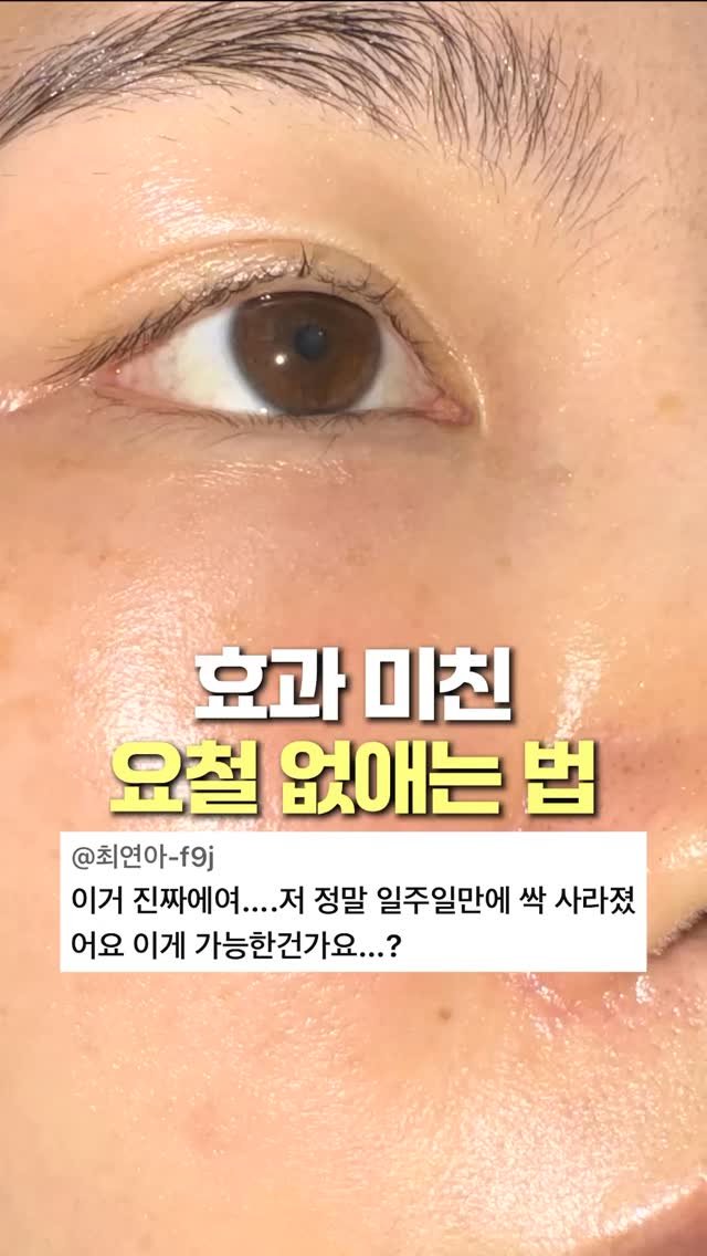 1star2star_ 게시물 이미지: 요철을 없애려면⁉️

1️⃣ 비우기 (BHA,PHA,AHA 사용추천)

✔️BHA...