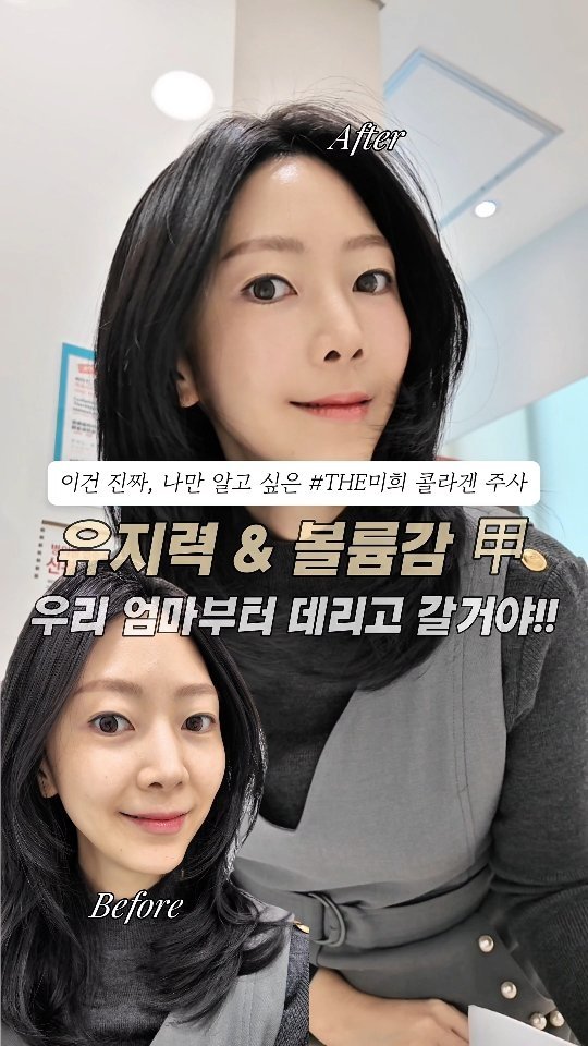 24oldfency 게시물 이미지: #광고 @themihee9 THE미희 콜라겐 주사💉

출산 후 꺼진 볼륨 개선을...