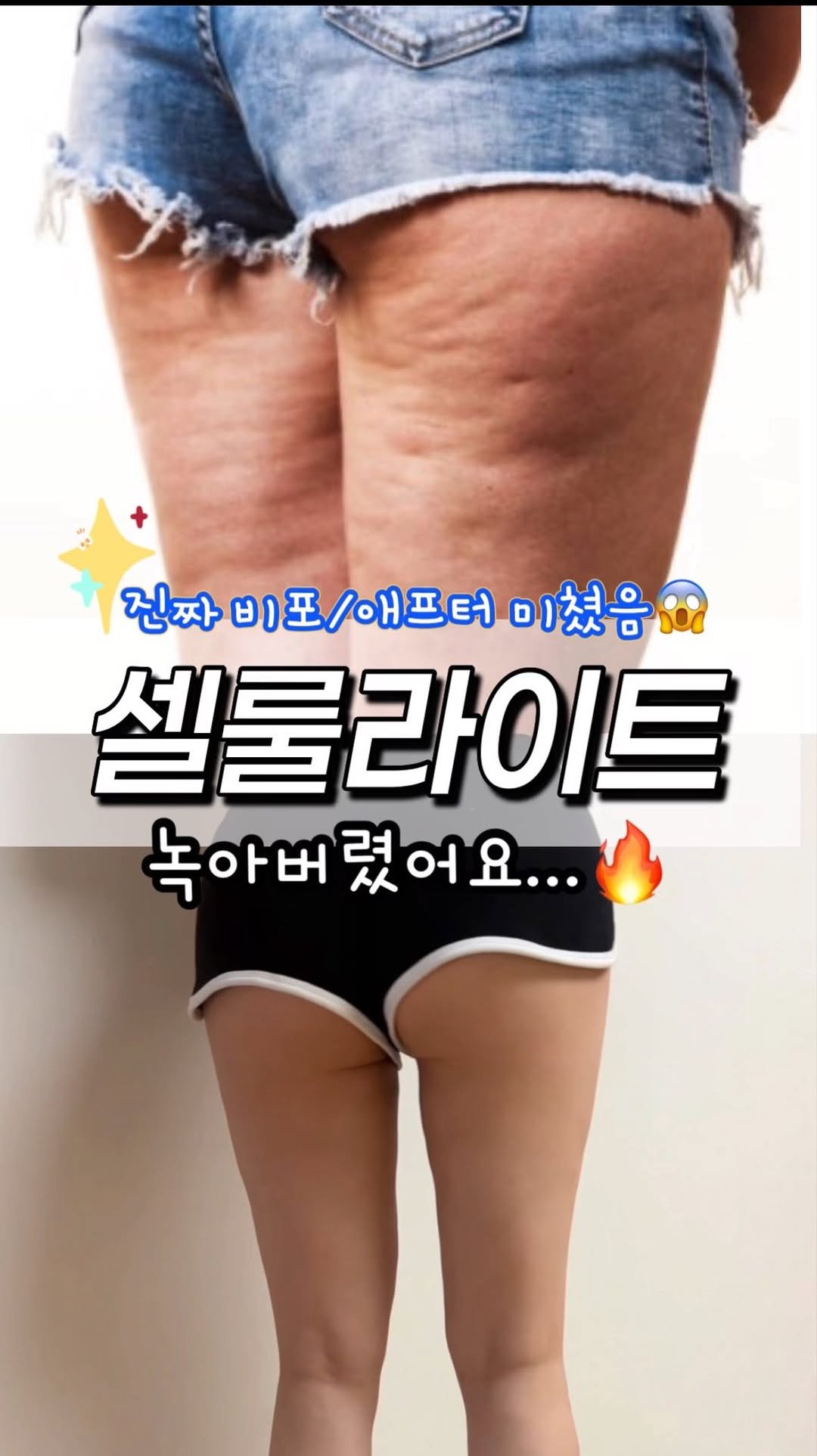 3.18oz 게시물 이미지: 여름만 되면 신경쓰이는 #셀룰라이트 !!!
저만 그런거 아니죠?😳

반바지 너무...