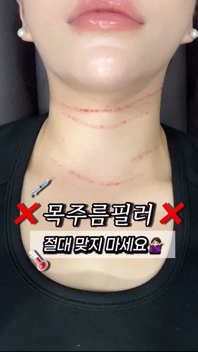 3.18oz 게시물 이미지: 제가 어렸을때부터 #목주름 은 갖고태어나서
어느순간부터 너무...