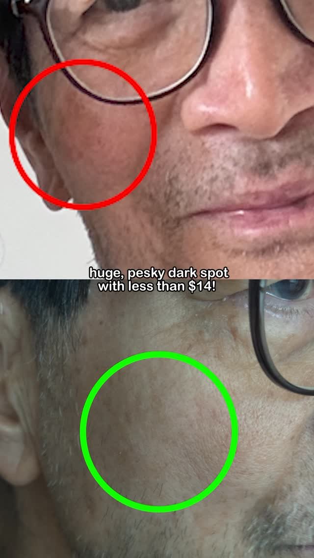 Euniunni 게시물 이미지: How Papa Cho got rid of his huge pesky dark...