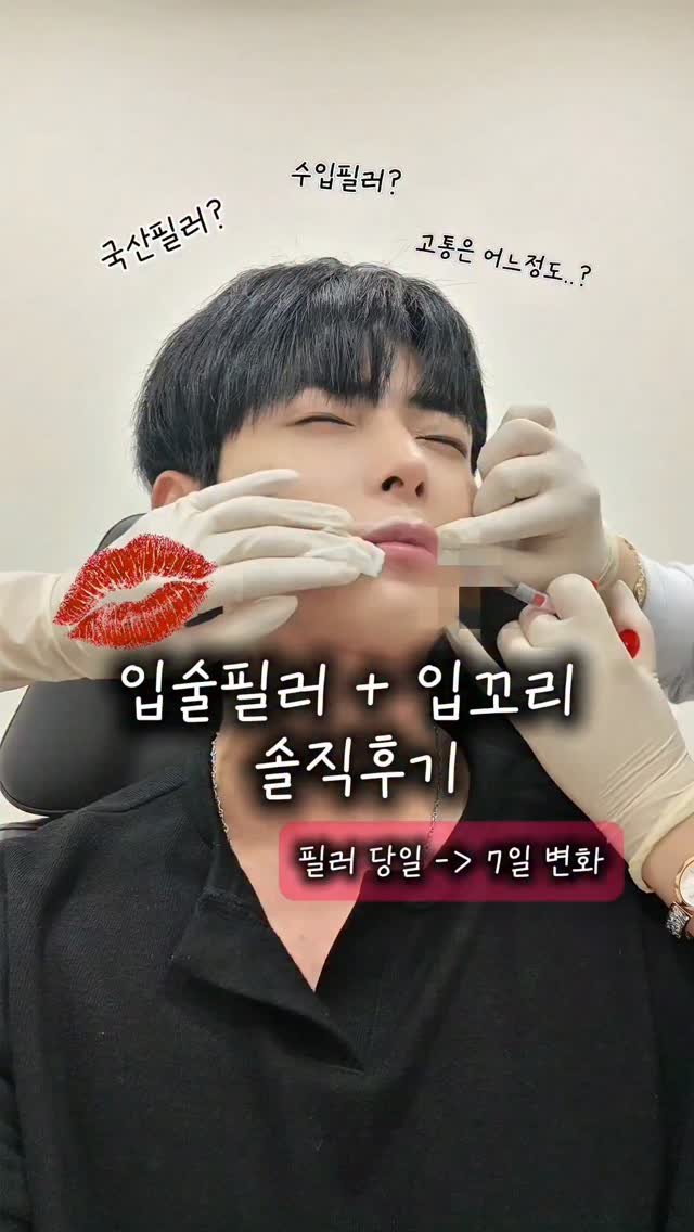 Keon_uuj 게시물 이미지: 원래 윗입술이 얇은 편이라 주변에서
입술 필러 추천을 정말 많이 받았는데, 
이번에...