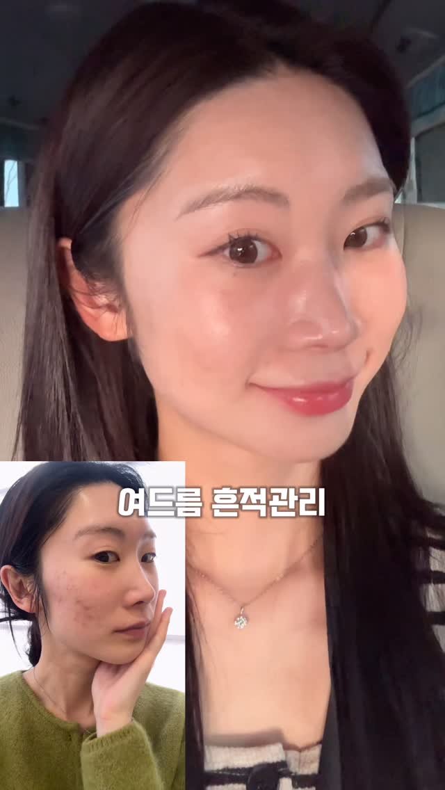 Yaji9696 게시물 이미지: 저는 여드름이 한번 올라오면
붉게 끝나는 게 아니라 브라운 색소 자국처럼 남는...