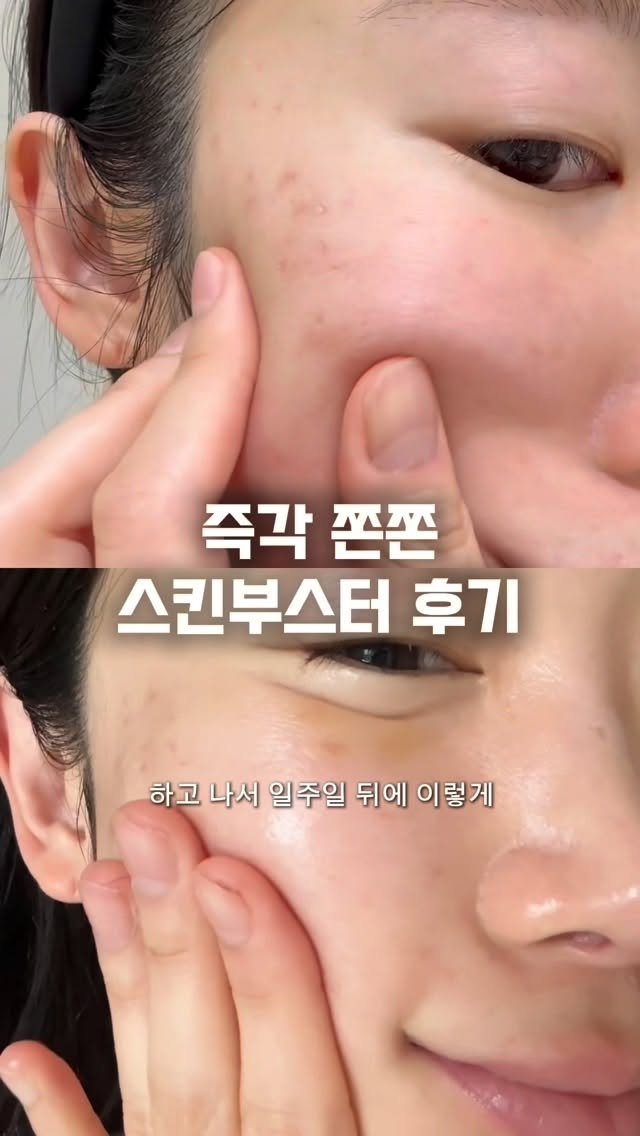 Yaji9696 게시물 이미지: 저는 레이저는 딱 필요한 만큼만
필러는 입술 필러 한번 받고
보톡스는 잘 안...