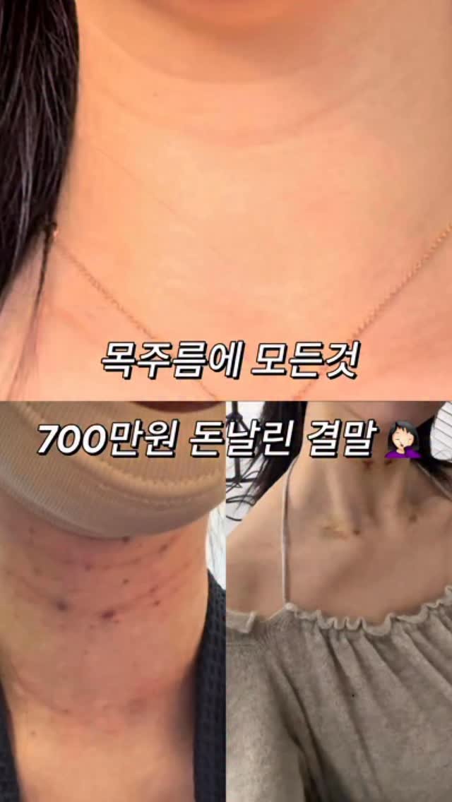 ___seoan 게시물 이미지: 저 올해만 목주름에 700만원썼지만 
만족하는 결과 얻은적이 없어서 영상...