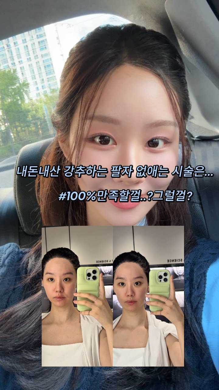 ___seoan 게시물 이미지: 팔자 시술 정보 궁금하신 분들!  시술 정보 공유 드려요 ! 팔자 시술했던 정보...