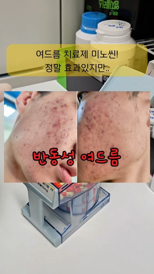 __kang.yaksa 게시물 이미지: 17세 아들.. 미노씬 안먹이는 이유입니다🤣
여드름에 효과가 좋지만
좋은 균을...