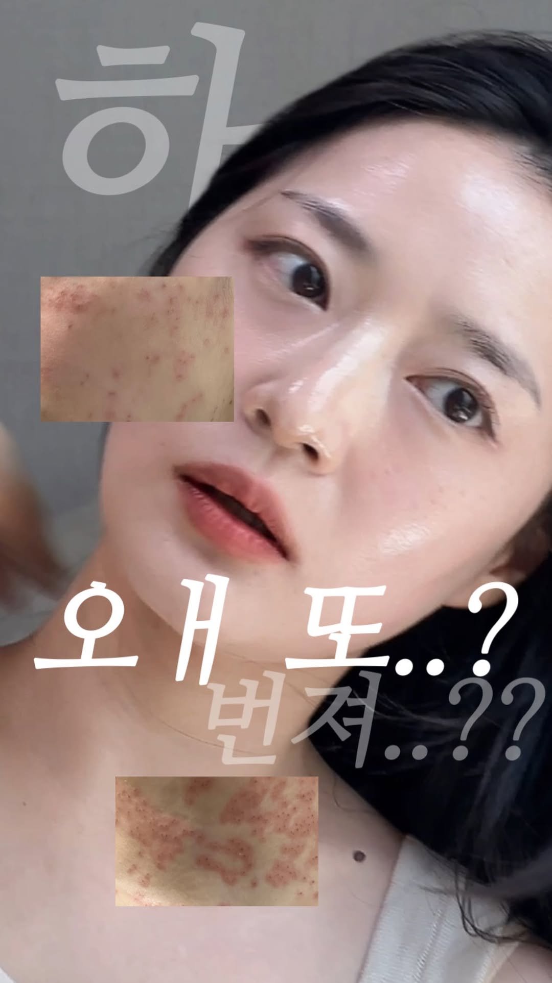 _rimply 게시물 이미지: 편평사마귀를 치료하면서 정말 도움이 되고 싶어서
공부해보니, 한 가지를 확실히 알게...