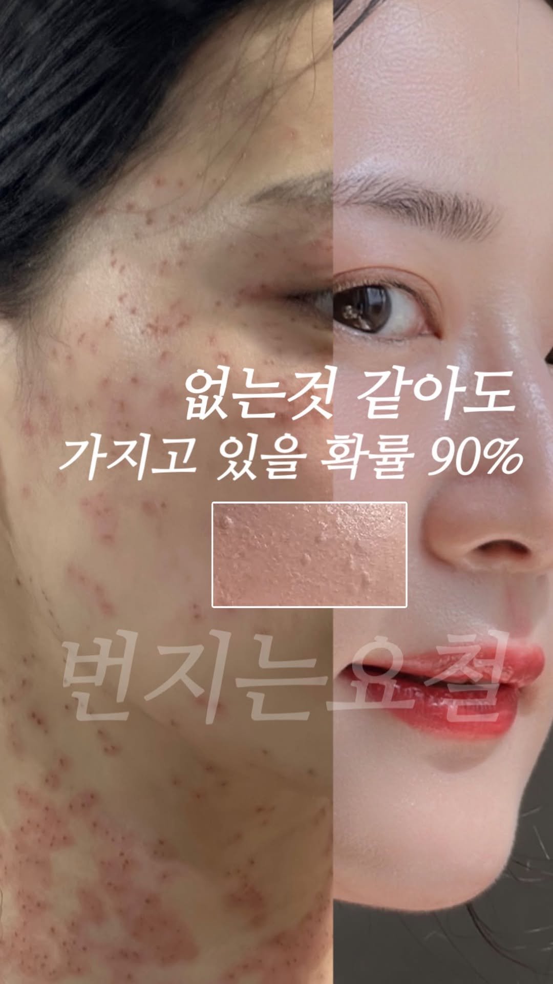 _rimply 게시물 이미지: 🚨 번지는 요철, 재발 잘 되는 요철 관리법 🚨
총 533만 뷰 🔥 #편평사마귀...