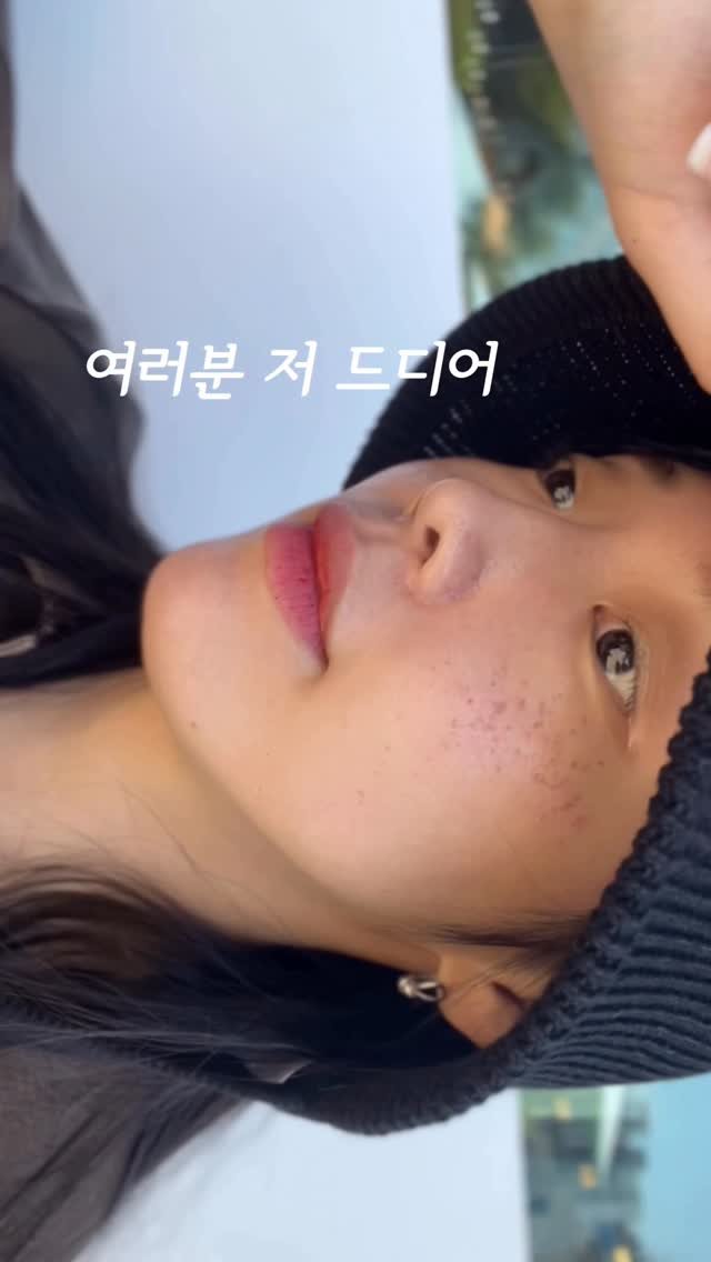 _yeom_ni_s_ 게시물 이미지: 제가 진짜 몇 년 전부터 고민했던 숙원사업,,
주근깨&기미 드디어 한 방에...