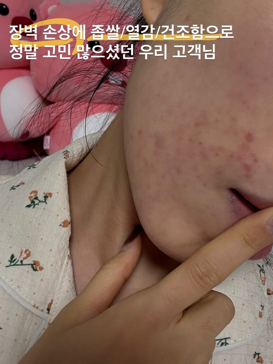 Photo shared by 웰빙앤스파 작은대장 - 수현🐽 on February 13, 2026 tagging @a.esthetic01. May be an image of text that says '장벽 손상에 좁쌀 싹/열감/건조함으로 열감 건조함으로 정말 고민 많으셨던 우리 고객님'.