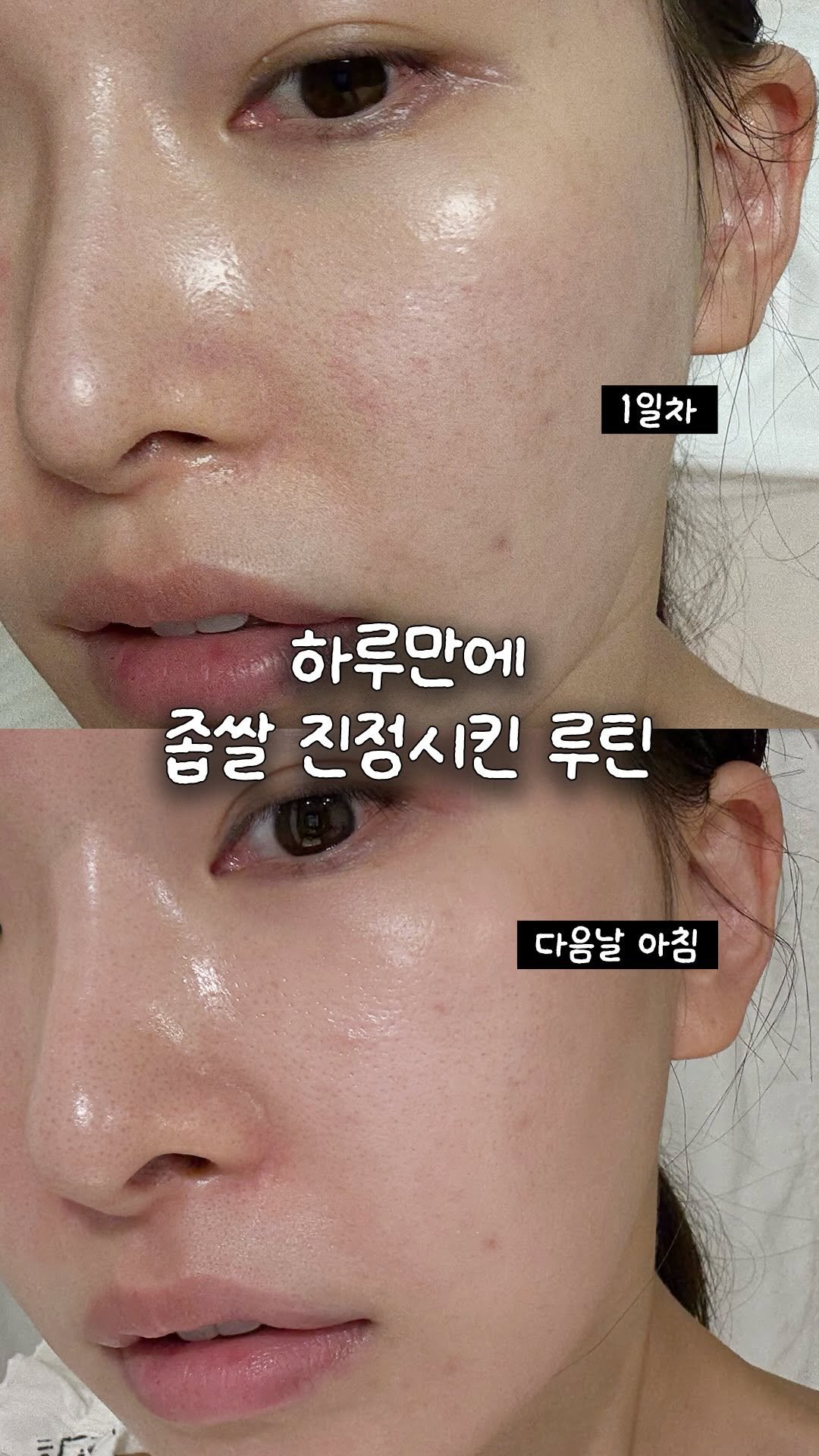 a_arang_ 게시물 이미지: 몰랑이들 반응이 너무 좋아서
매일 루틴 올려보려고 해요
트러블 진정보다는
트러블이...