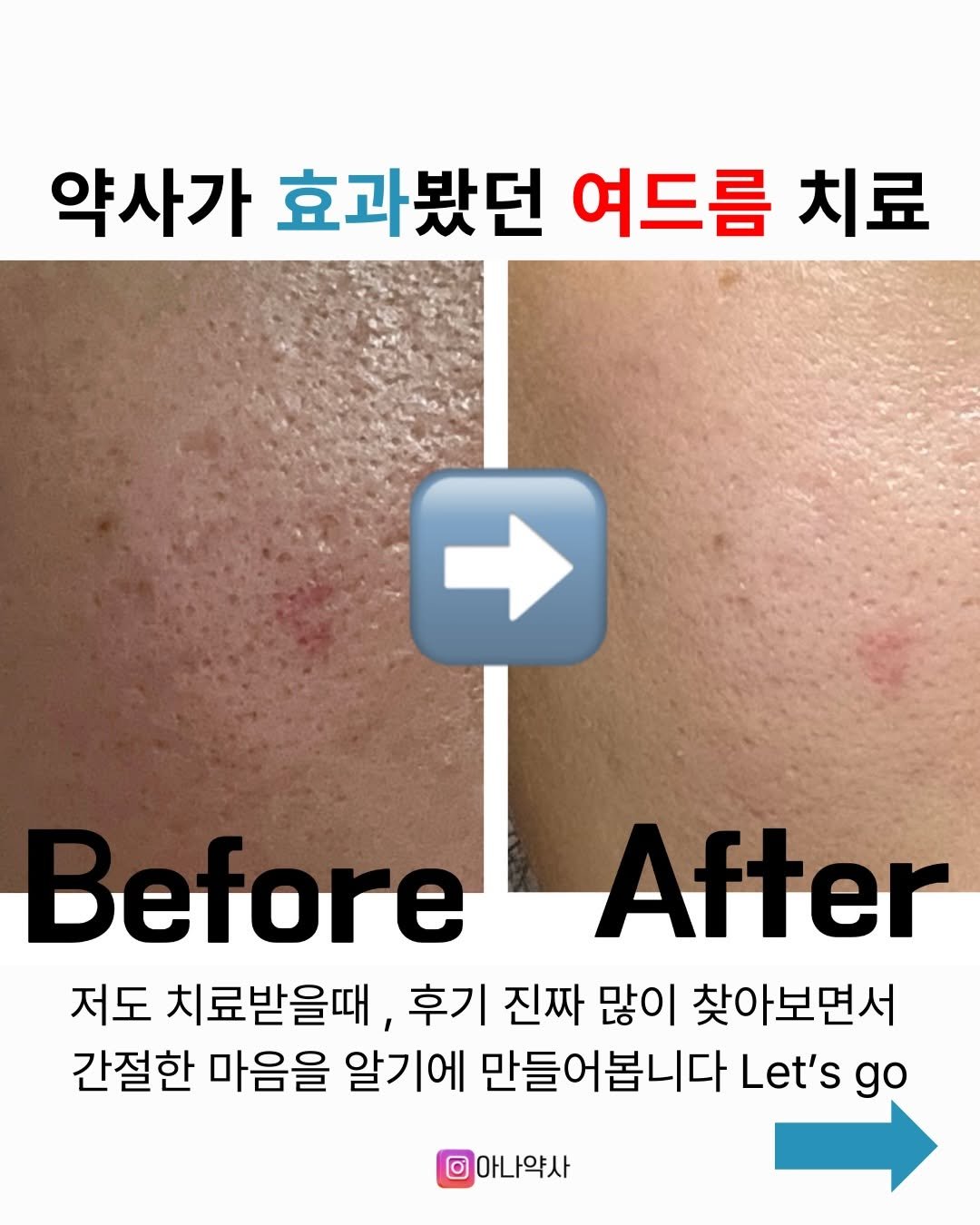 Photo by 아나약사  | 김진아  health • beauty on December 08, 2025. May be an image of text that says '약사가 효과봤던 여드름 치료 Detore After 저도 치료받을때, 후기 진짜 많이 찾아보면서 간절한 마음을 알기에 만들어봅니다 Let's go 아나약사'.