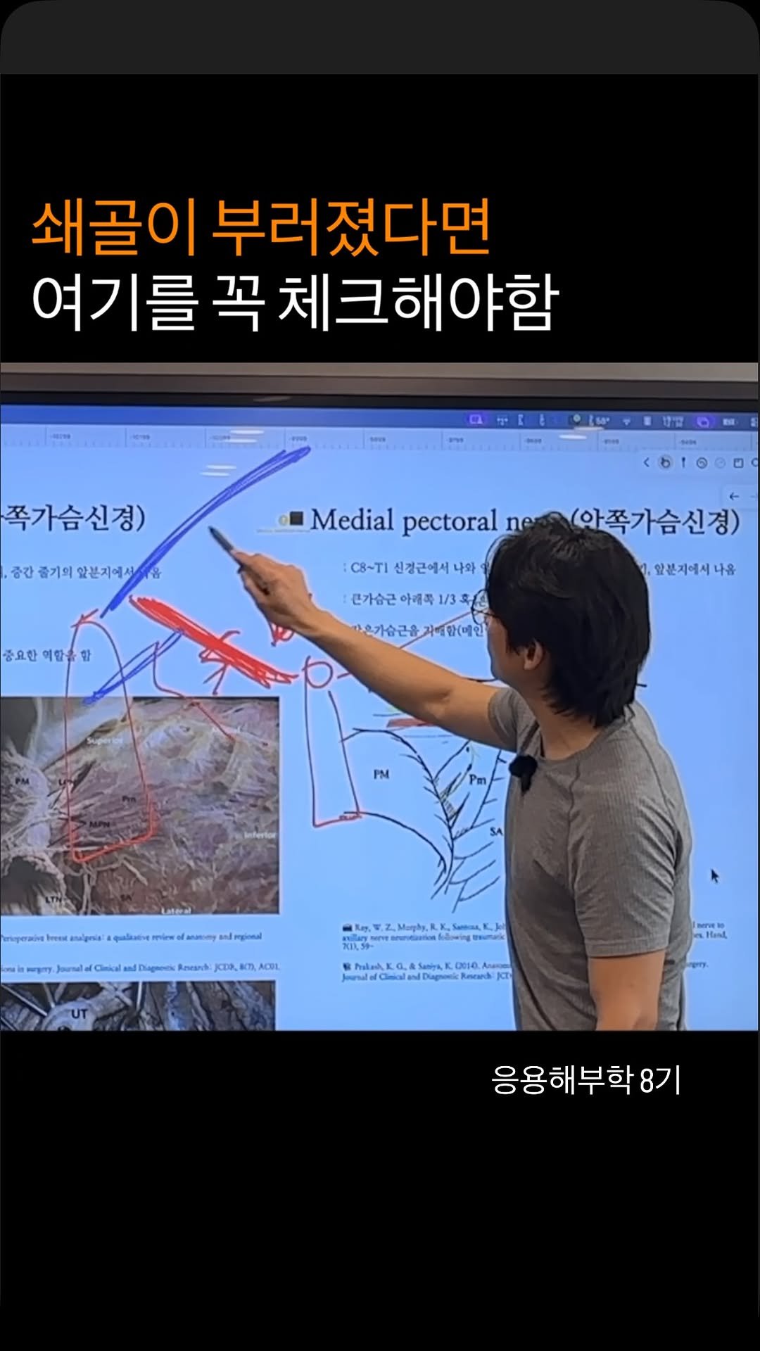 anatomy_n_training 게시물 이미지: 쇄골은 진짜 재활 잘 해야함