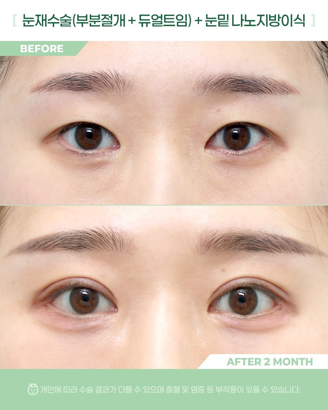 Photo by 비포애프 박재범 on January 02, 2026. May be an image of text that says 'BEFORE 눈재수술(부분절개+ + 듀얼트임) + 눈밑 나노지방이식 AFTER AFTER2MONTH 2 MONTH 개인에 따라 따라수술 수술 결과가 다를 수 있으며 출혈 및 염증 등 부작용이 있을 수 있습니다.'.