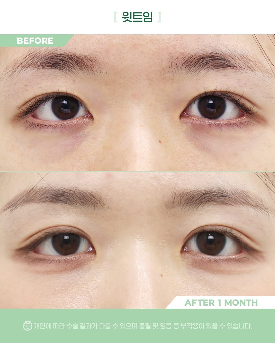 Photo by 비포애프 박재범 on April 13, 2026. May be an image of text that says 'BEFORE 윗트임 所/ AFTER AFTER1MONTH 1 MONTH 개인에따라수술걸과가다를수 개인에 따라 수술 결과가 다를 수 있으며 출혈 및 염증 등 부작용이 있을 수 있습니다.'.