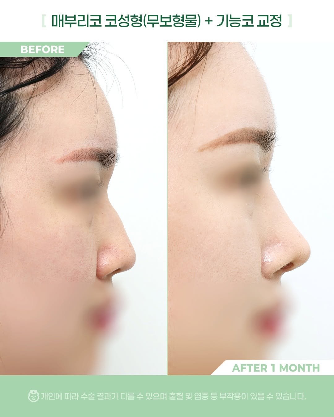 Photo by 비포애프 박재범 on January 15, 2026. May be an image of text that says 'BEFORE 매부리코 코성형( (무보형물) 코성형(무보형물) + 기능코교정 교정] ] 기능코 AFTER AFTER1MONTH 1 MONTH 개인에 따라 수술 결과가 다를 수 있으며 출혈 및 염증 등 부작용이 있을 수 있습니다.'.