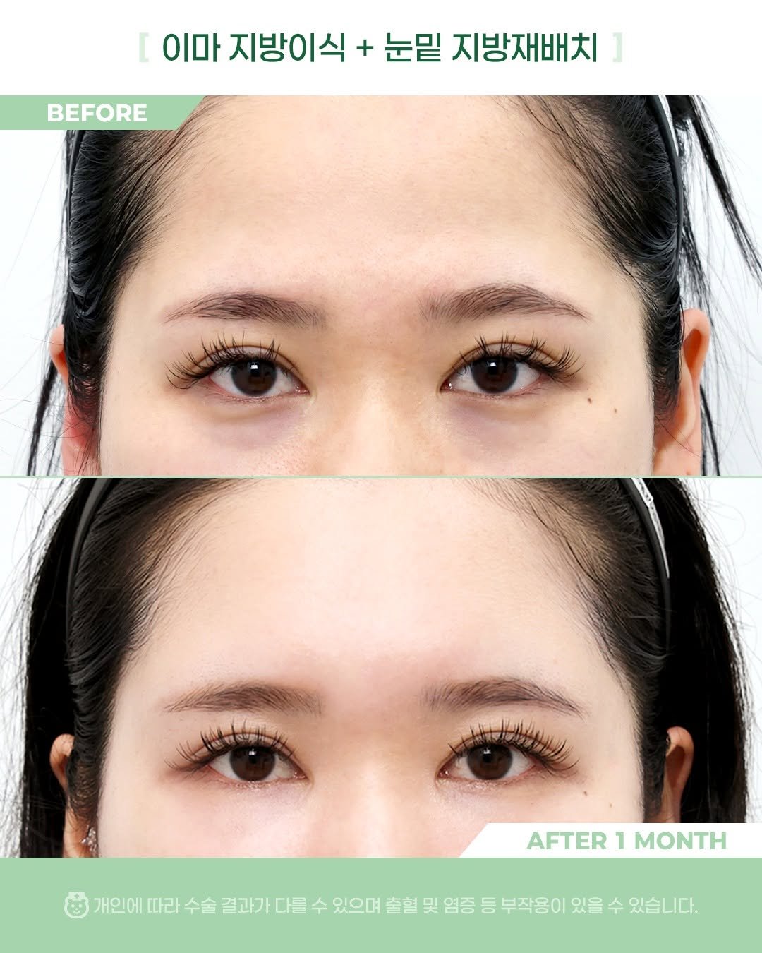 Photo by 비포애프 박재범 on January 06, 2026. May be an image of text that says '[ 이마 지방이식 + 눈밑 지방재배치 ] BEFORE 上ナ AFTER AFTER1MONTH 1 MONTH 개인에 따라 수술 결과가 다를 수 있으며 출혈 및 염증 등 부작용이 있을 수 있습니다.'.