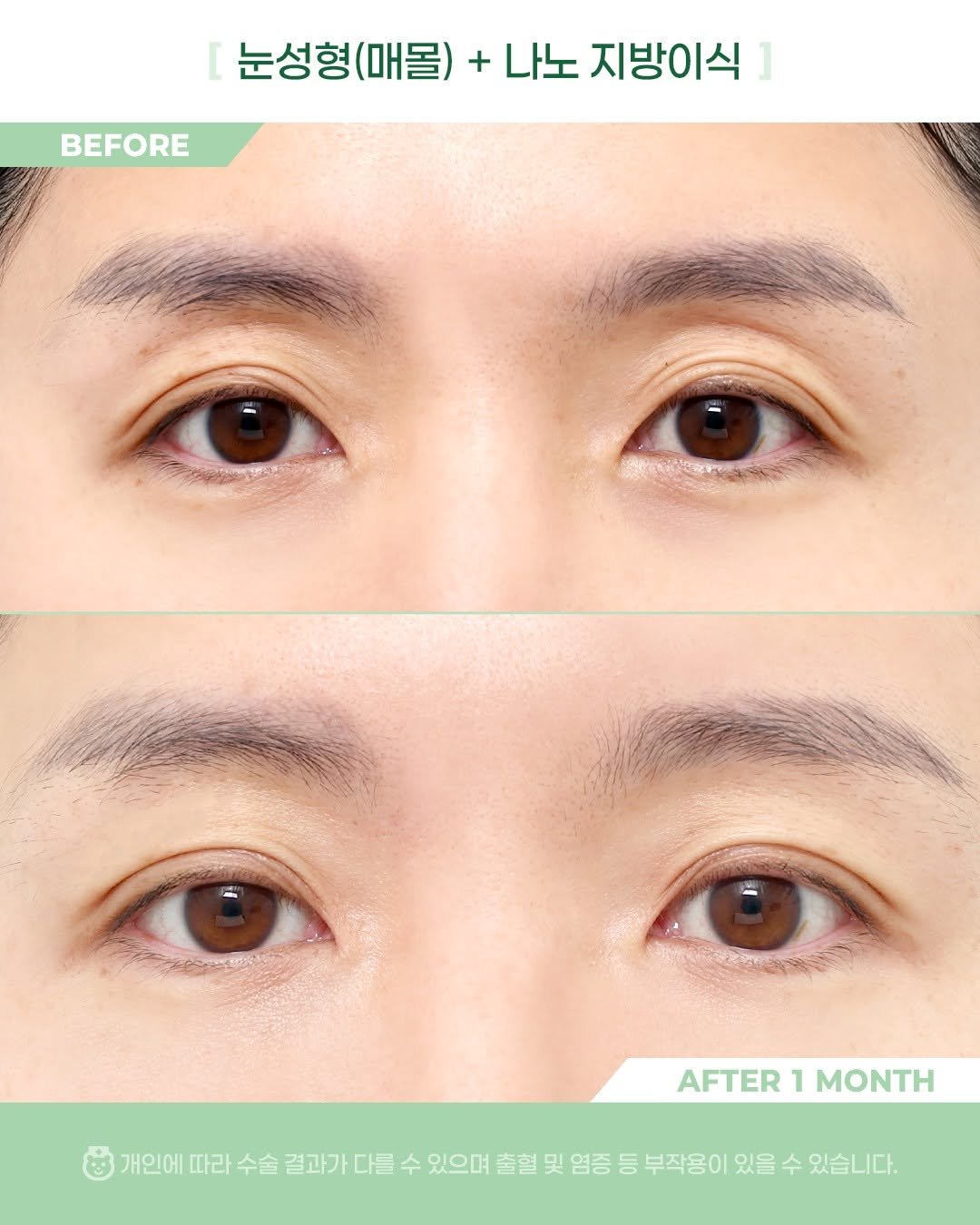 Photo by 비포애프 박재범 on January 29, 2026. May be an image of text that says 'BEFORE 눈성형(매물) 눈성형(매돌)+나노지방이식] 눈성형 + 나노 지방이식 ] AFTER AFTER1MONTH 1 MONTH 개인에 따라 수술 결과가 다를 수 있으며 출혈 및 염증 등 부작용이 있을 수 있습니다.'.