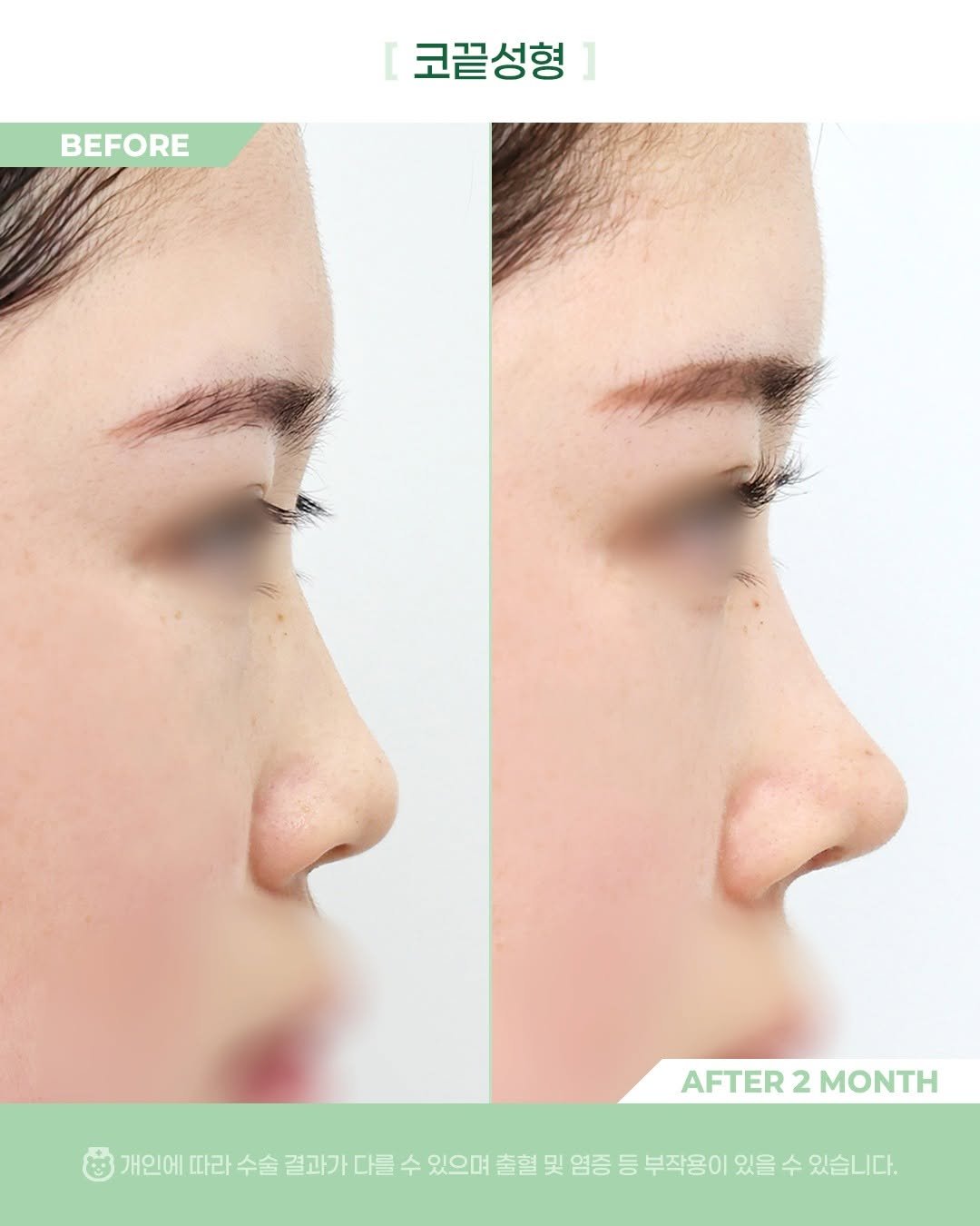Photo by 비포애프 박재범 on November 11, 2025. May be an image of text that says 'BEFORE 코끝성형 AFTER AFTER2MONTH 2 MONTH 개인에 따라 수술 결과가 다를 수 있으며 출혈 및 염증 등 부작용이 있을 수 있습니다.'.