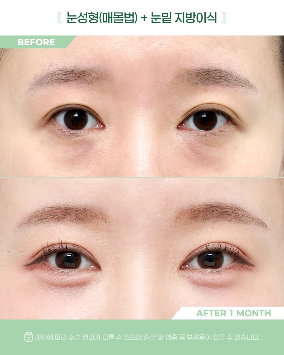 Photo by 비포애프 박재범 on January 29, 2026. May be an image of text that says '눈성형(매몰법) (매몰법) + 눈밑 지방이식 눈성형 BEFORE AFTER AFTER1MONTH 1 MONTH 개인에 따라 수술 결과가 다를 수 있으며 출혈 및 염증 등 부작용이 있을 수 있습니다.'.