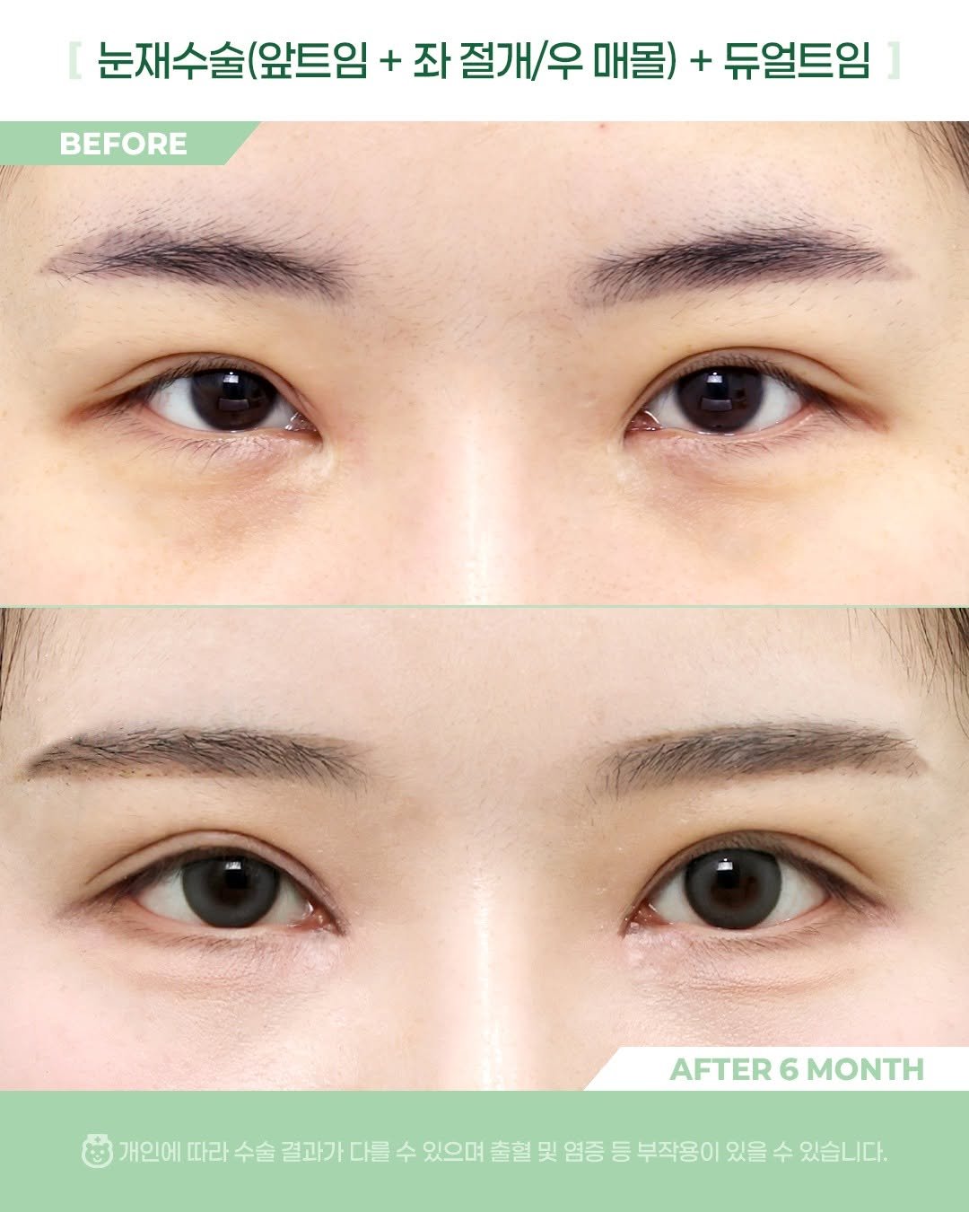 Photo by 비포애프 박재범 on October 21, 2025. May be an image of text that says 'BEFORE 눈재수술(앞트임 + 좌 절개/우 매몰) + 듀얼트임 AFTER AFTER6MONTH 6 MONTH 개인에 따라 수술 결과가 다를 결과가다를 수 있으며 출혈 및 염증 등 부작용이 있을 수 있습니다.'.