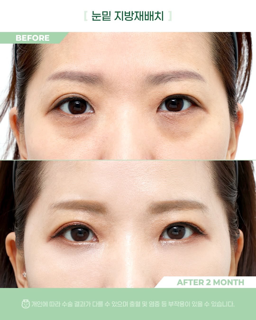 Photo by 비포애프 박재범 on January 28, 2026. May be an image of text that says 'BEFORE 눈밑 지방재배치 AFTER AFTER2MONTH 2 MONTH 개인에 따라 수술 결과가 다들 수 있으며 출혈 및 염증 등 부작용이 있을 수 있습니다.'.