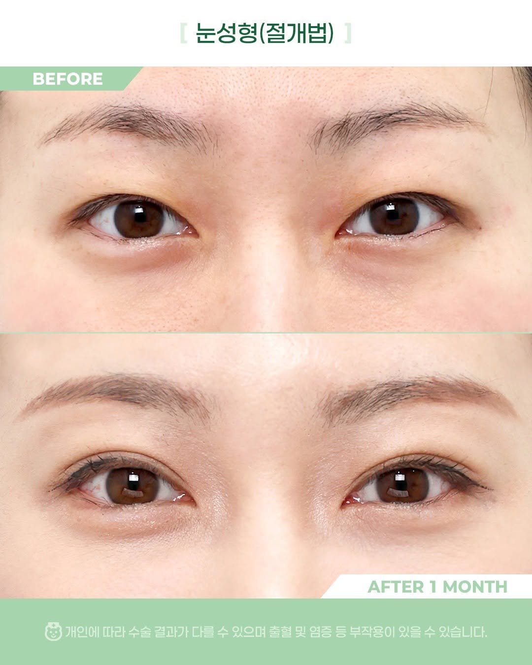Photo by 비포애프 박재범 on November 02, 2025. May be an image of text that says 'BEFORE 눈성형(절개법) 눈성형 (절개법) AFTER AFTER1MONTH 1 MONTH 개인에따라수술걸과가다를 개인에 따라 수술 결과가 다를 수 있으며 출혈 및 염증 등 부작용이 있을 수 있습니다.'.