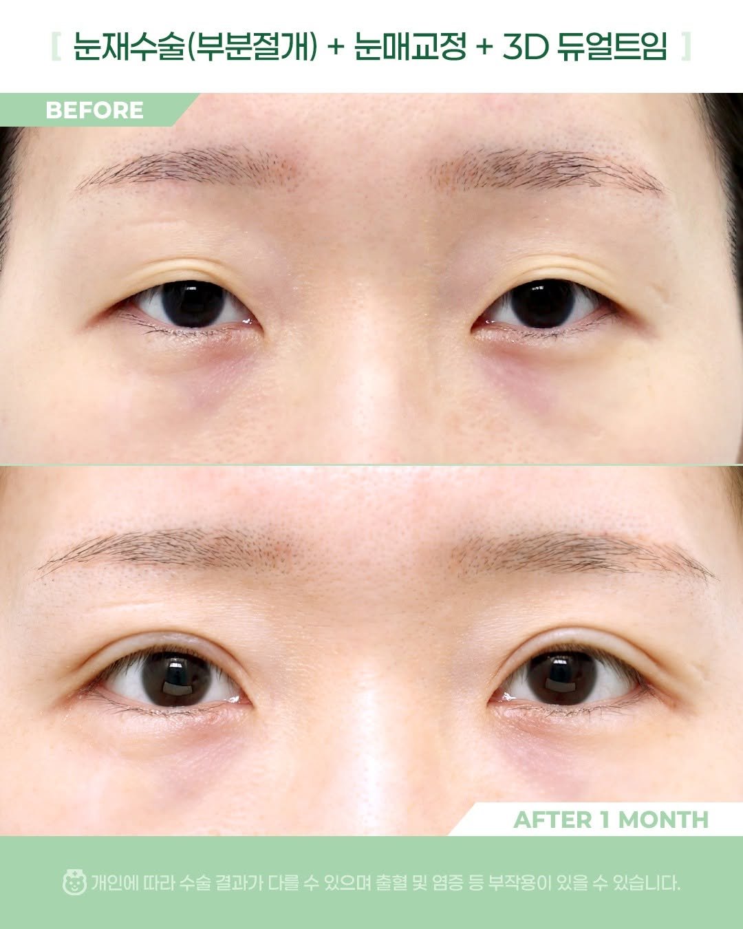 Photo by 비포애프 박재범 on October 21, 2025. May be an image of text that says 'BEFORE 눈재수술(부분절개) (부분절개) + 눈매교정 + 3D 듀얼트임 눈재수술 AFTER AFTER1MONTH 1 MONTH 개인에 따라 수술 결과가 다를 수 있으며 출혈 출혈및영증등부작용이있을수있습니다. 및 염증 등 부작용이 있을 수 있습니다.'.