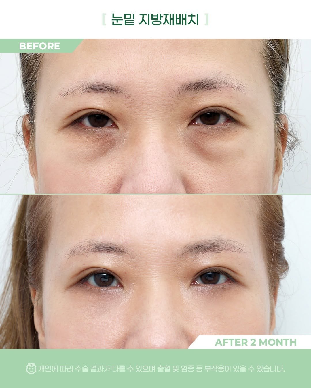 Photo by 비포애프 박재범 on January 28, 2026. May be an image of text that says 'BEFORE 눈밑 지방재배치 ] AFTER AFTER2MONTH 2 MONTH 개인에 따라 수술 결과가 결과가다를 다를 수 있으며 출혈 및 염증 등 부작용이 있을 수 있습니다.'.