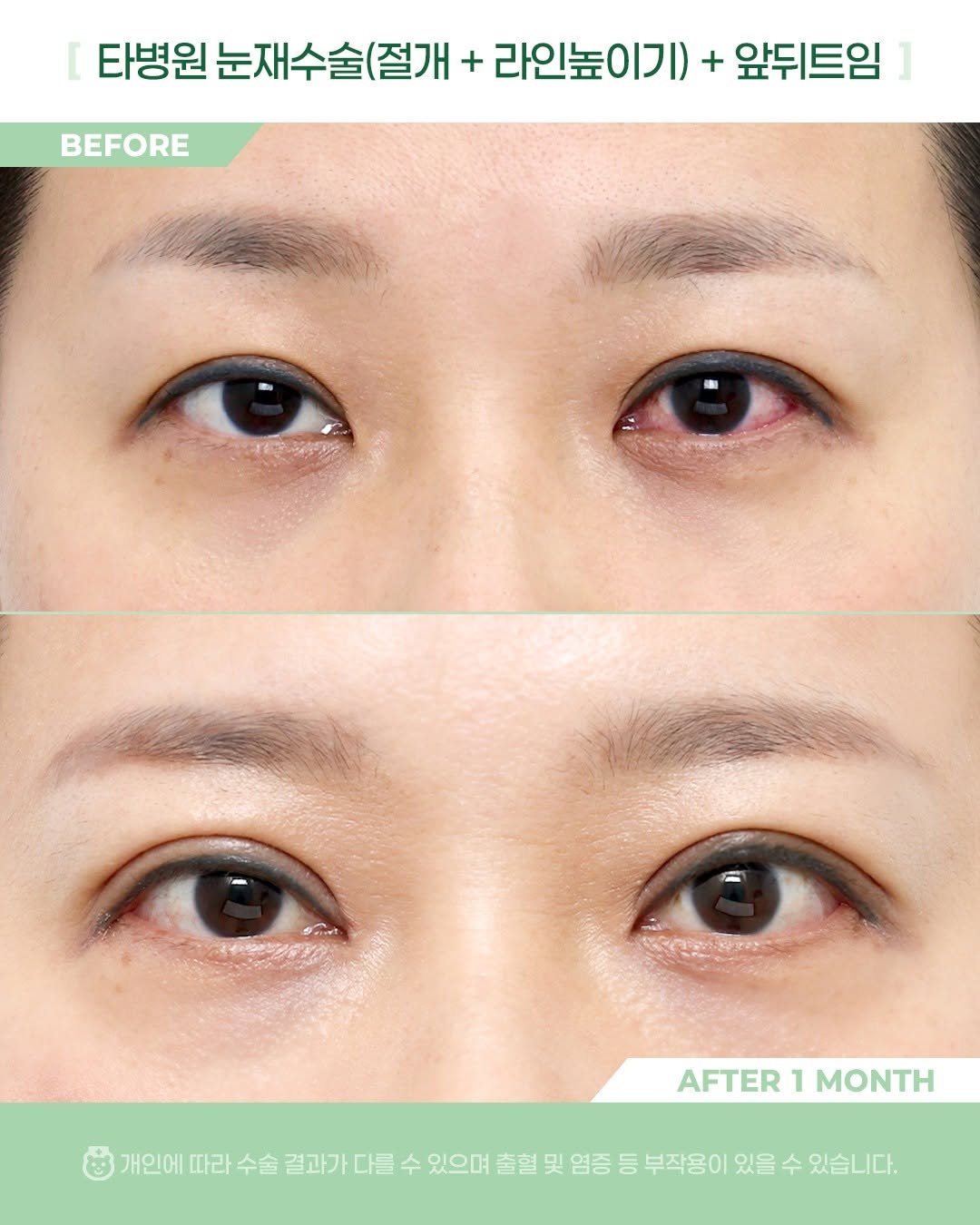 Photo by 비포애프 박재범 on January 02, 2026. May be an image of text that says 'BEFORE 타병원눈재수술(절개+ 타병원 눈재수술(절개 + 라인높이기) 라인높 + 앞뒤트임 AFTER AFTER1MONTH 1 MONTH 개인에 따라 수술 결과가 결과가다를 다를 수 있으며 출혈 및 염증 등 부작용이 있을 수 있습니다.'.