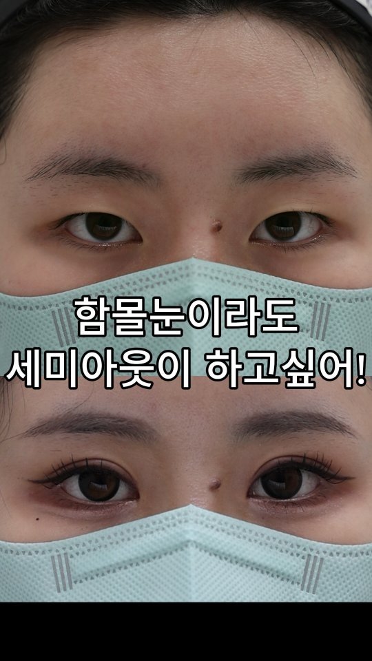 b4fps_official 게시물 이미지: 많이들 세미아웃,시원한 인아웃을 원하지만... 
눈뼈에 비해 안구가 들어가 있는...