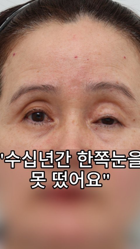 b4fps_official 게시물 이미지: "감사합니다". 30년간 대학병원에서도 수술후 실패.. 재수술을 고민했지만 결과는...