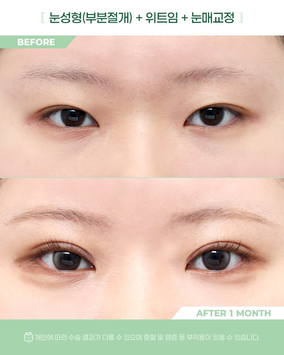 Photo by 비포애프 박재범 on February 10, 2026. May be an image of text that says '눈성형 (부분절개) + 위트임 + 눈매교정 BEFORE ツ AFTER AFTER1MONTH 1 MONTH 개인에 따라 수술 결과가 다를 수 있으며 출혈 및 염증 등 부작용이 있을 수 있습니다.'.