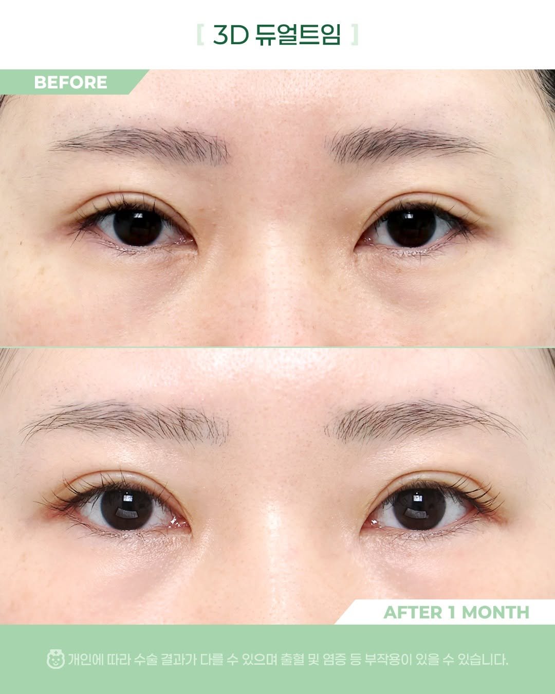 Photo by 비포애프 박재범 on April 13, 2026. May be an image of text that says 'BEFORE 3D 듀얼트임 D듀얼트임] ] AFTER AFTER1MONTH 1 MONTH 개인에 따라 수술 결과가 다를 수 있으며 출혈 및 염증 등 부작용이 있을 수 있습니다.'.
