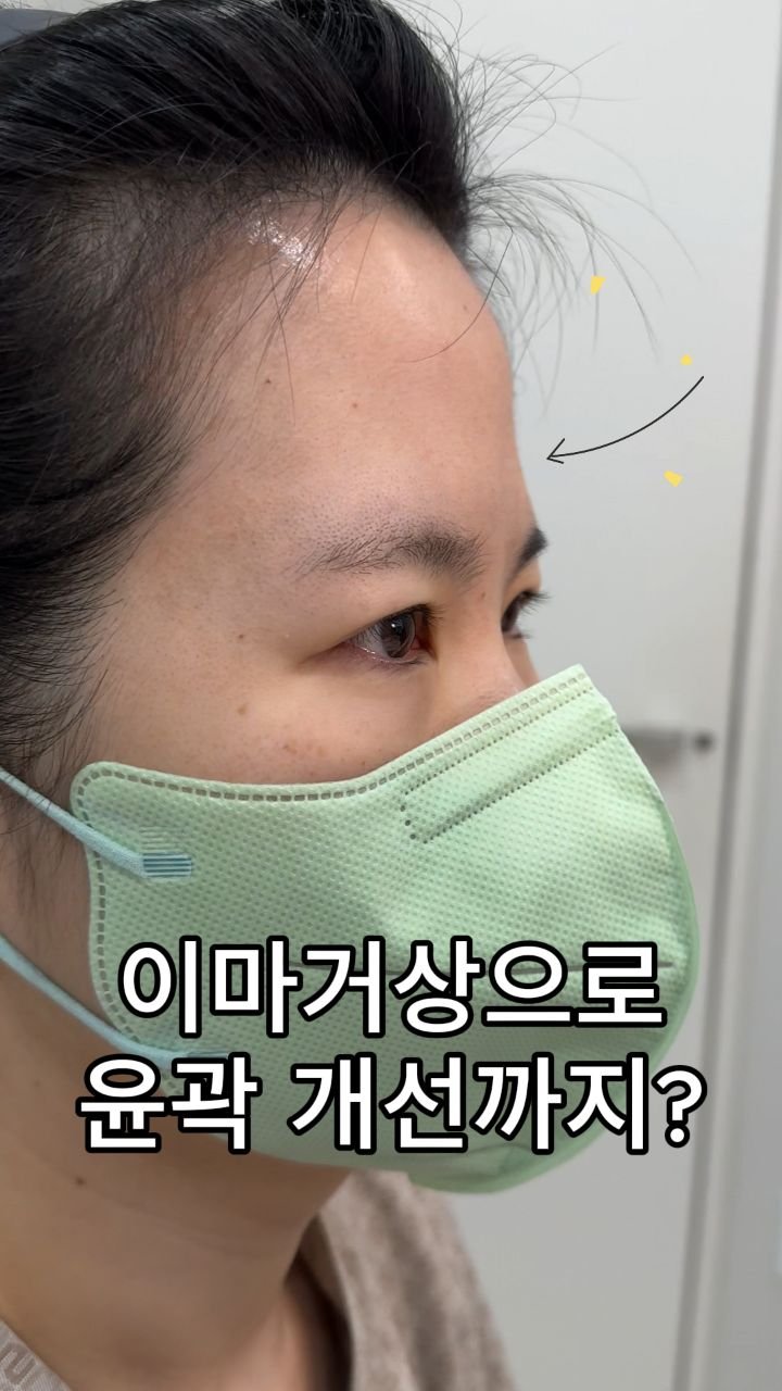 b4fps_official 게시물 이미지: 절개로 과거에 쌍꺼풀을 했지만 덮혀서 보이지않아 오셨던 분입니다.
이마거상을 할경우...