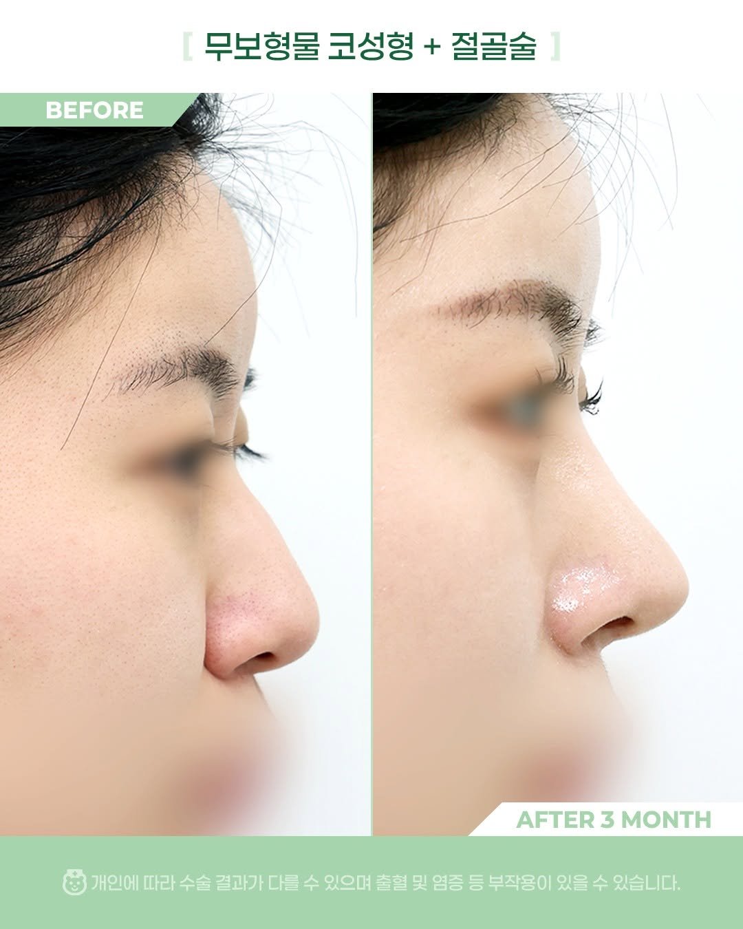 Photo by 비포애프 박재범 on November 11, 2025. May be an image of text that says 'BEFORE 무보형물 코성형 + 절골술 AFTER AFTER3MONTH 3 MONTH 개인에 따라 수술 결과가 다를 수 있으며 출혈 및 염증 등 부작용이 있을 수 있습니다.'.