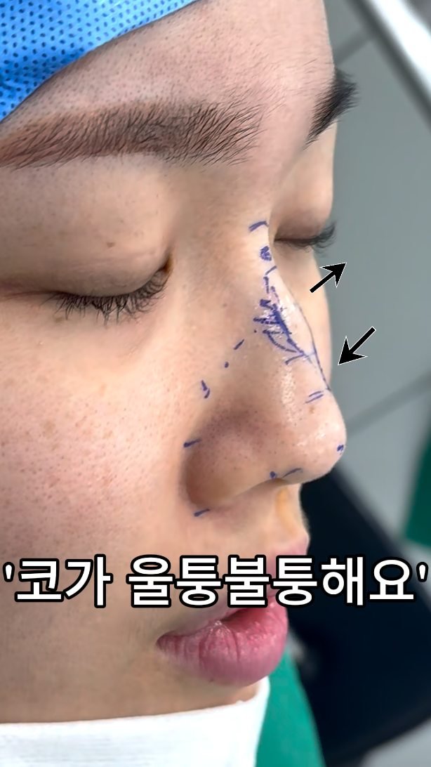 b4fps_official 게시물 이미지: 귀연골과 휜 비중격을 함께 활용했습니다! 

수술명:비중격만곡증 교정+보형물...