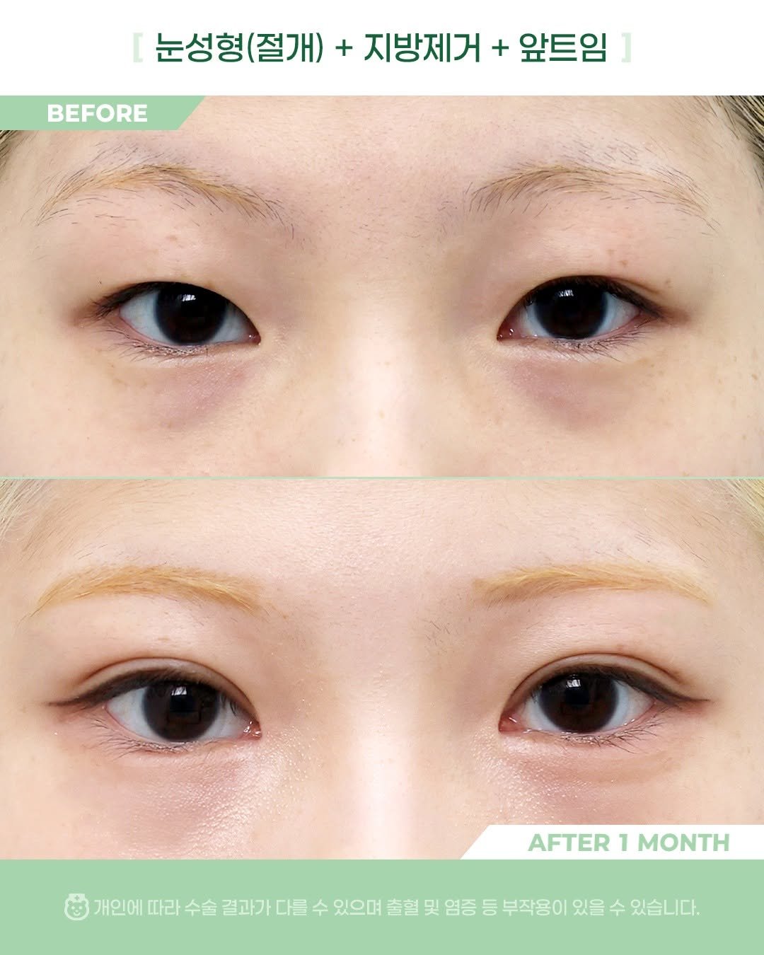 Photo by 비포애프 박재범 on November 02, 2025. May be an image of text that says 'BEFORE 눈성형(절개) + 지방제거 + 앞트임 ] AFTER AFTER1MONTH 1 MONTH 개인에 따라 수술 결과가 다를 수 있으며 출혈 및 염증 등 부작용이 있을 수 있습니다.'.