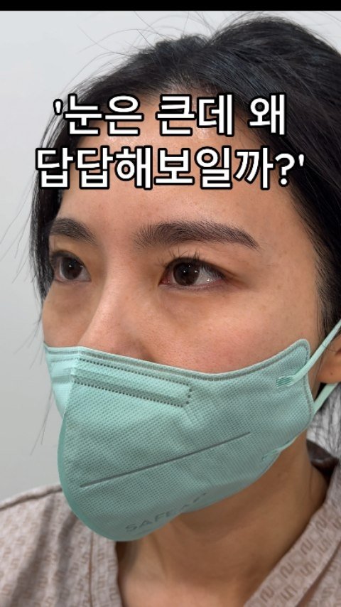 b4fps_official 게시물 이미지: 눈은 큰데 왜 답답해보일까요?
쌍수가 아닌 이마리프팅이 답입니다!

- 수술명 :...
