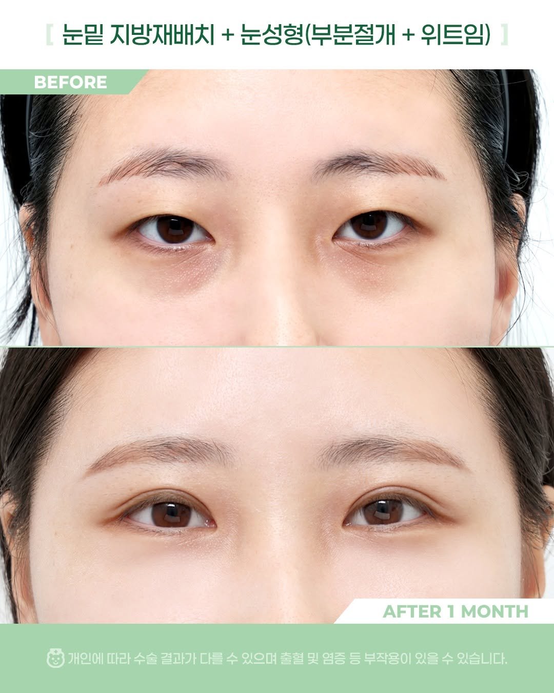 Photo by 비포애프 박재범 on January 06, 2026. May be an image of text that says '눈밑 지방재배치 + 눈성형 눈성형(부분절개 + 위트임) BEFORE AFTER AFTER1MONTH 1 MONTH 개인에 따라 수술 결과가 다를 수 있으며 출혈 및 염증 등 부작용이 있을 수 있습니다.'.
