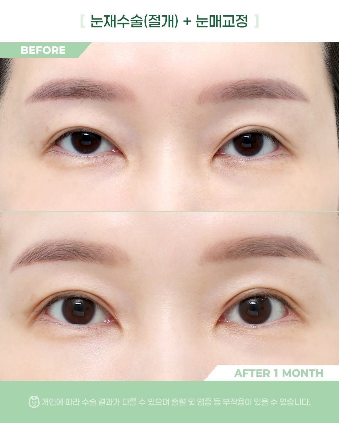 Photo by 비포애프 박재범 on April 15, 2026. May be an image of one or more people, eyeliner and text that says '[ 눈재수술(절개)+눈마 + 눈매교정 눈재수술(절 (절개) BEFORE AFTER AFTER1MONTH 1 MONTH 개인에 따라 수술 결과가 결과가다를 다를 수 있으며 출혈 및 염증 등 부작용이 있을 수 있습니다.'.