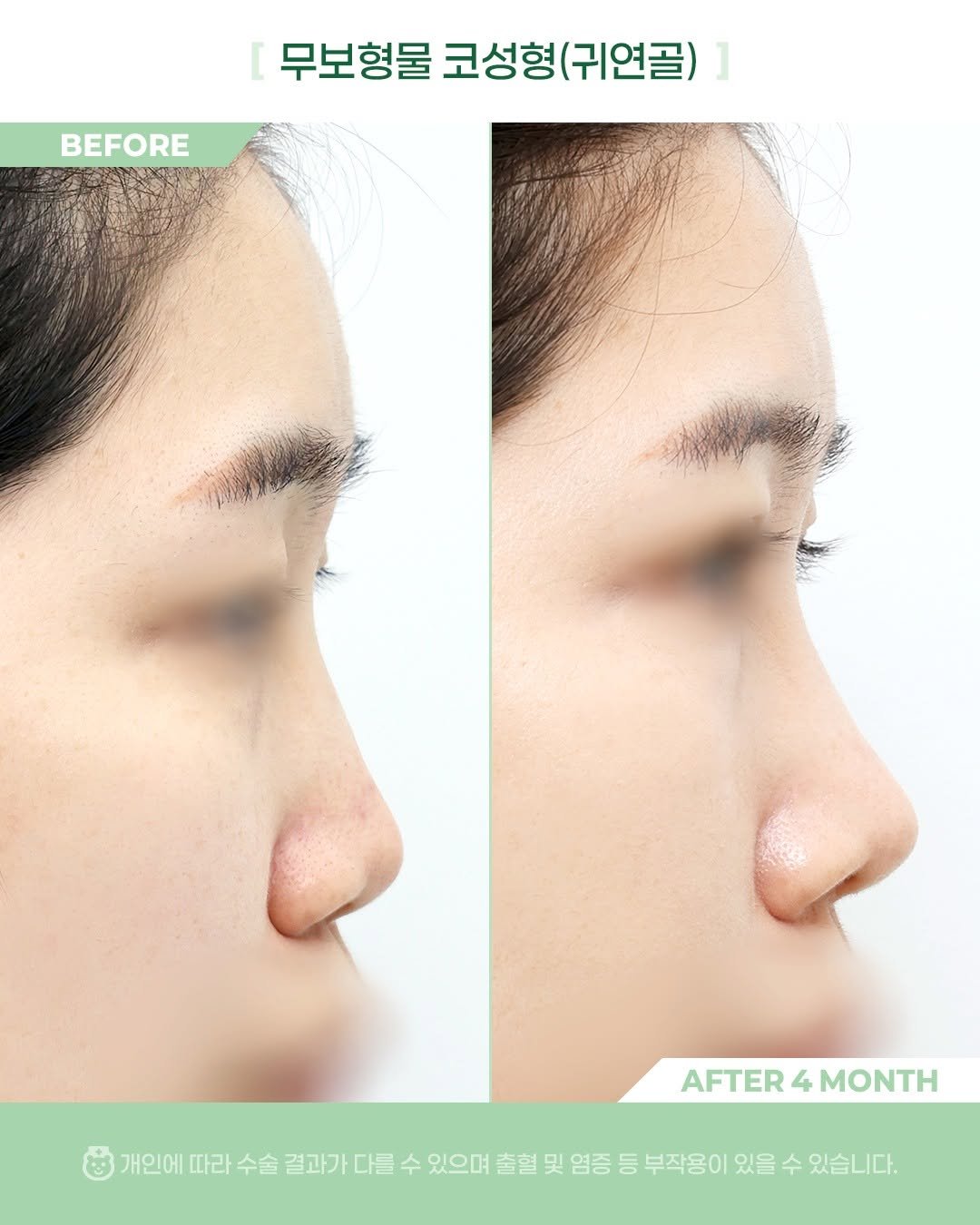 Photo by 비포애프 박재범 on November 11, 2025. May be an image of text that says 'BEFORE 무보형물 코성형 코성형(귀연골) 무보형물코성형(귀연골) (귀연골) AFTER AFTER4MONTH 4 MONTH 개인에 따라 수술 결과가 다를 수 있으며 출혈 및 염증 등 부작용이 있을 수 있습니다.'.