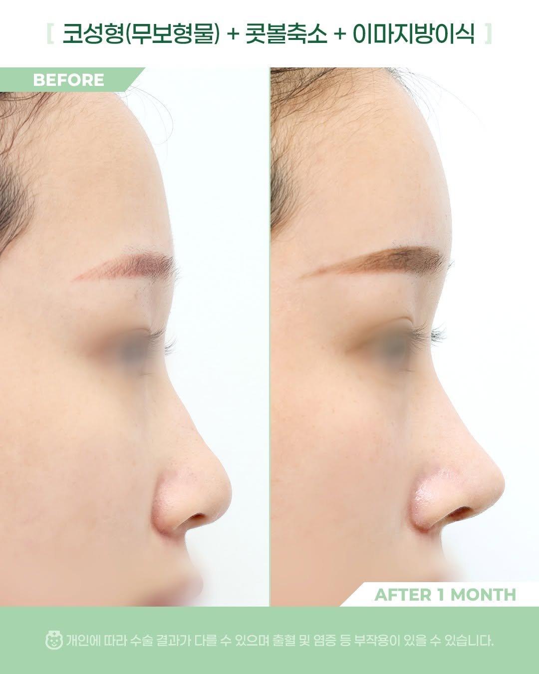 Photo by 비포애프 박재범 on April 02, 2026. May be an image of text that says 'BEFORE 코성형(무보형물) + 콧볼축소+ + 이마지방이식 고성형(무보형률)+콧불축소+이마지방이식 ] 코성형( AFTER AFTER1MONTH 1 MONTH 개인에 따라 會 결과가다를 결과가 다를 수 있으며 출혈 및 염증 등 부작용이 있을 수 있습니다.'.