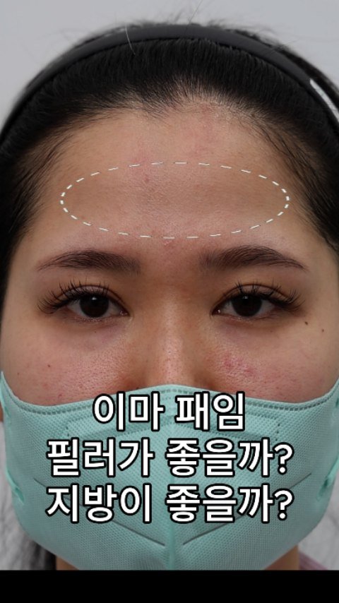 b4fps_official 게시물 이미지: 성형외과 의사들이 필러 대신 지방 추천하는 이유.
1년 지나서 없어지는 필러와 달리...