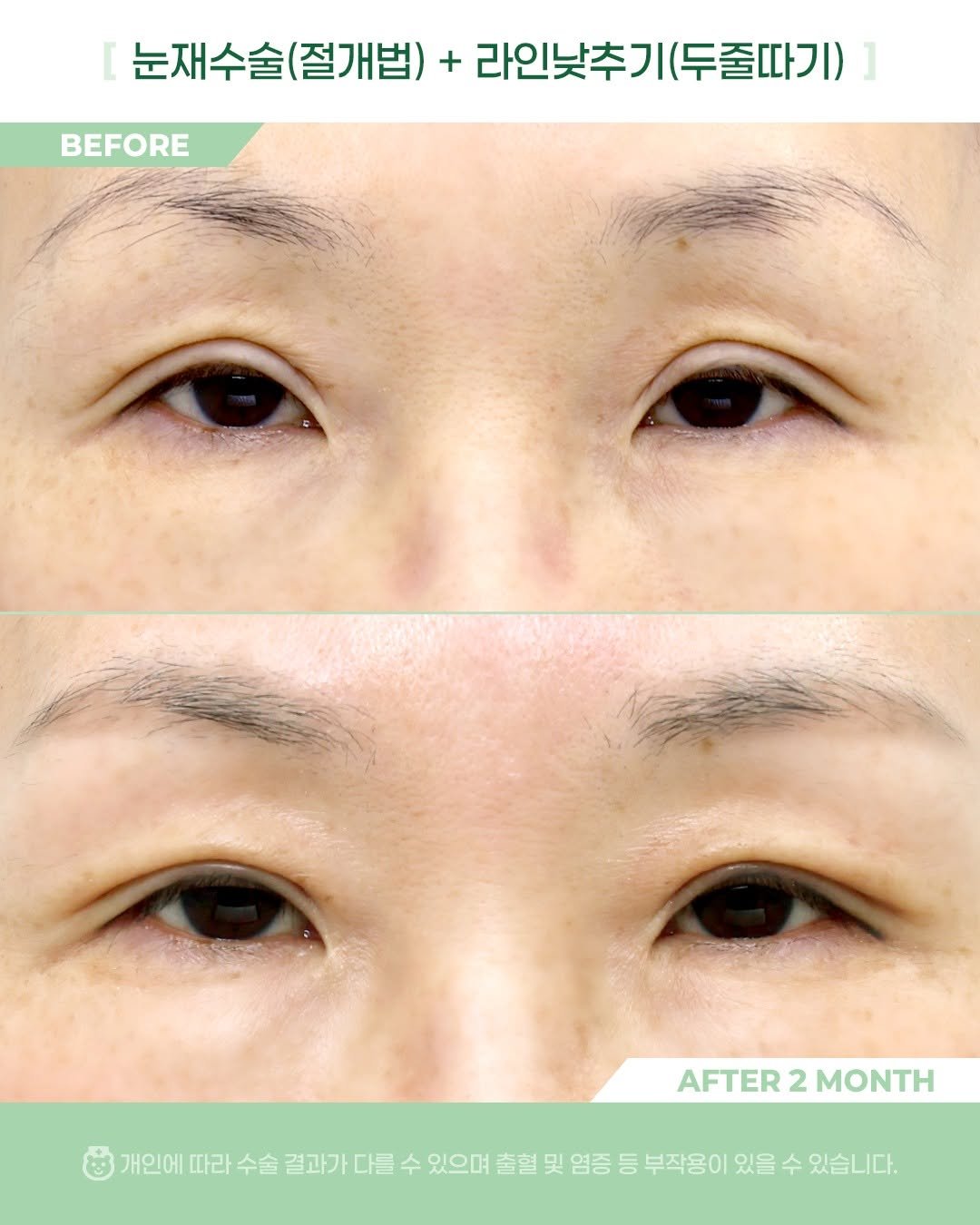 Photo by 비포애프 박재범 on November 02, 2025. May be an image of text that says '눈재수술(절개법) (절개법) + 눈재수술( 술(절개별)+라인낮추기(두줄따기) 라인낮추기 라인낮추기(두줄따기) BEFORE AFTER AFTER2MONTH 2 MONTH 개인에 따라 수술 결과가 다를 수 있으며 출혈 및 염증 등 부작용이 있을 수 있습니다.'.